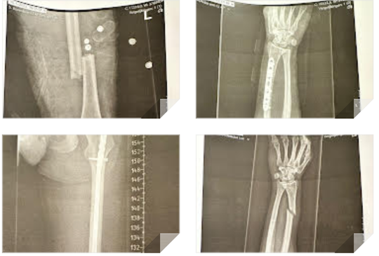X-ray scans of the left arm and leg showing fractures treated with surgical implants including metal rods, screws, and plates after a motorcycle crash.